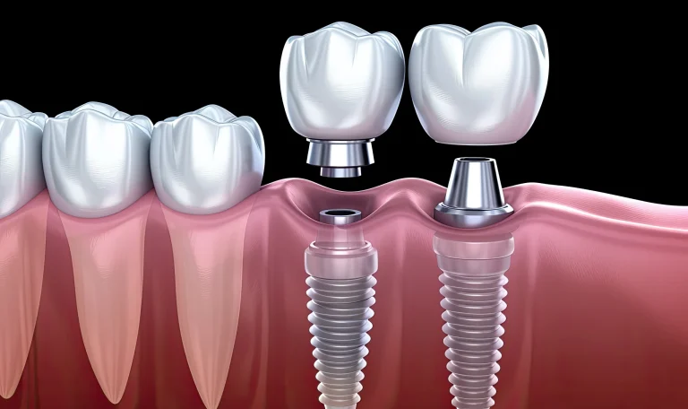 Implant Tedavisi Scaled 1