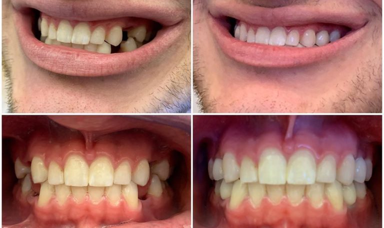 Aynı Gün Implant Tedavisi, Diş Kaybı Yaşayan Bireylere Hızlı Çözüm Sunarak, Implant Yerleştirilip Üzerine Geçici Diş Yapılmasını Sağlar.