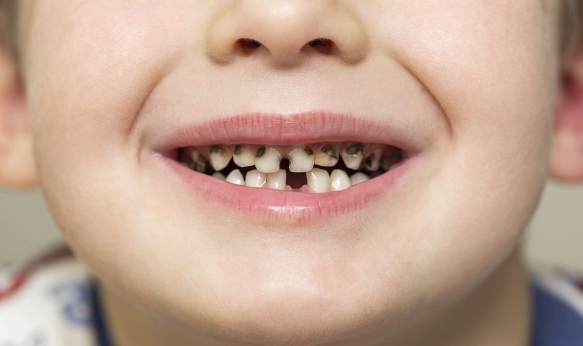 Süt Dişlerinde Çürük Oluşan Bir Çocuğun Diş Muayenesi.