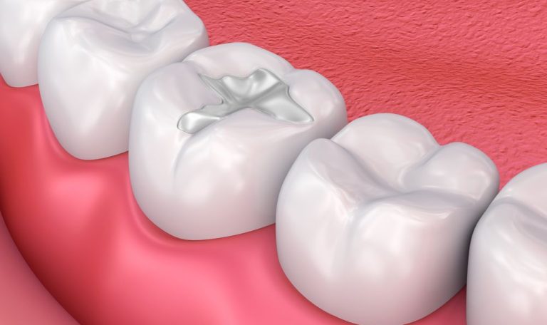 Farklı Malzemelerle Yapılmış Diş Dolgusu Örnekleri.