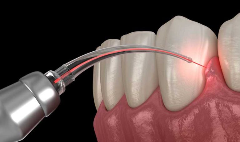 Diş Eti Çekilmesi Görülen Dişlerde Hassasiyet Ve Kök Yüzeyinin Açığa Çıkması.