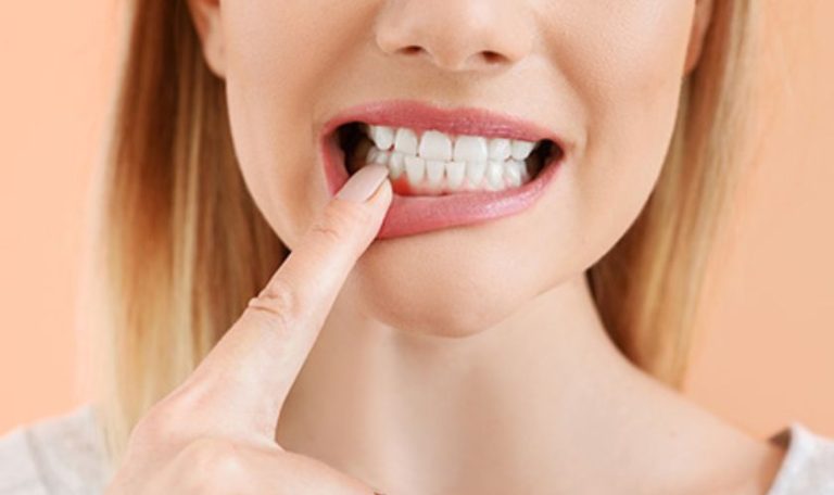 Diş Eti Şekillendirme Işlemi Öncesi Ve Sonrası Gülüş Estetiğinde Farkı Gösteren Fotoğraf.