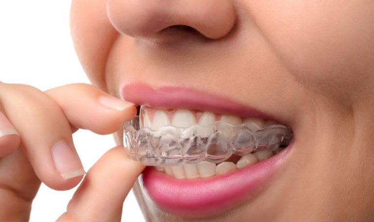 Gece Diş Sıkma Sorunu Yaşayan Kişi Için Kullanılan Şeffaf Gece Plağı.