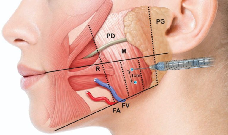 Diş Sıkma Tedavisinde Çene Kasına Botoks Uygulaması Yapılan Hasta.