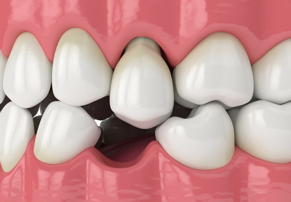 Eksik Dişlerin Yerine Farklı Tedavi Yöntemleriyle Uygulanan Protez Ve Implantların Karşılaştırıldığı Bir Görsel.