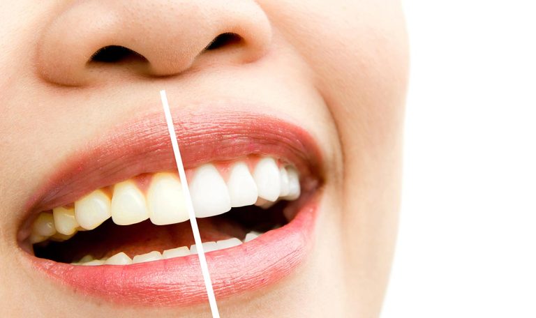 Gülüş Tasarımı, Kişinin Yüz Hatlarına Ve Estetik Beklentilerine Uygun Şekilde, Diş Ve Diş Etlerinin Şekillendirilmesi Sürecidir.