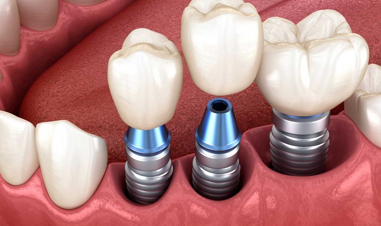 İmplant Dişlerin Çevresinin Dikkatlice Fırçalandığı Ve Temizlendiği Ağız Içi Görüntüsü.