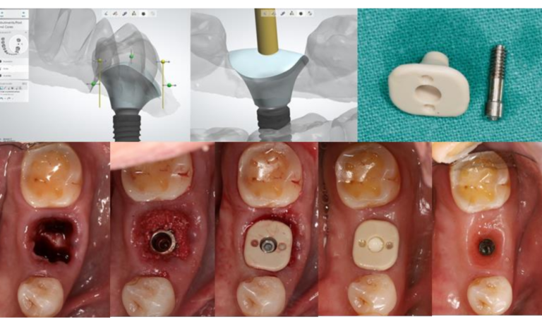 İmplant Tedavisi Sonrası Ağız Hijyenine Dikkat Eden Bir Hasta Ve Iyileşme Süreciyle Ilgili Bilgilendirici Görseller.