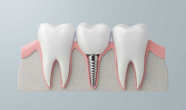 İmplant Tedavisinin Başarı Oranlarını Gösteren Grafik, Tedavi Sürecinin Etkili Sonuçlar Sunduğunu Vurgulamaktadır.