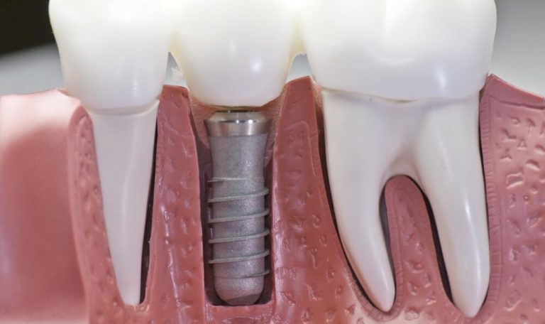 Ağız Içinde Yerleştirilmiş Diş Implantı Ve Üst Yapısı.