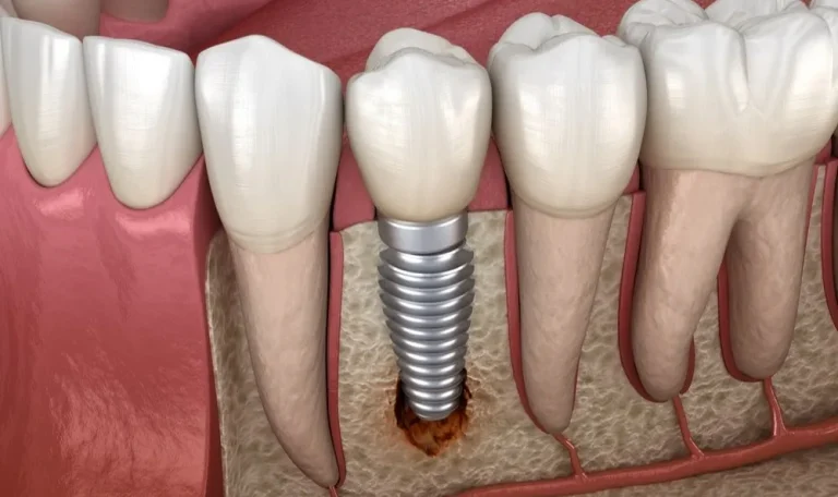 Diş Implantı Tedavisi Sonrası Hafif Ağrı Yaşayan Bir Hasta.