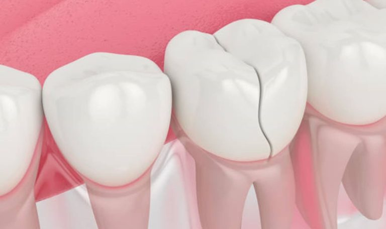 Kırık Dişin Onarımı Için Dolgu, Kaplama Ve Bonding Uygulamalarının Gösterildiği Diş Tedavi Süreci.