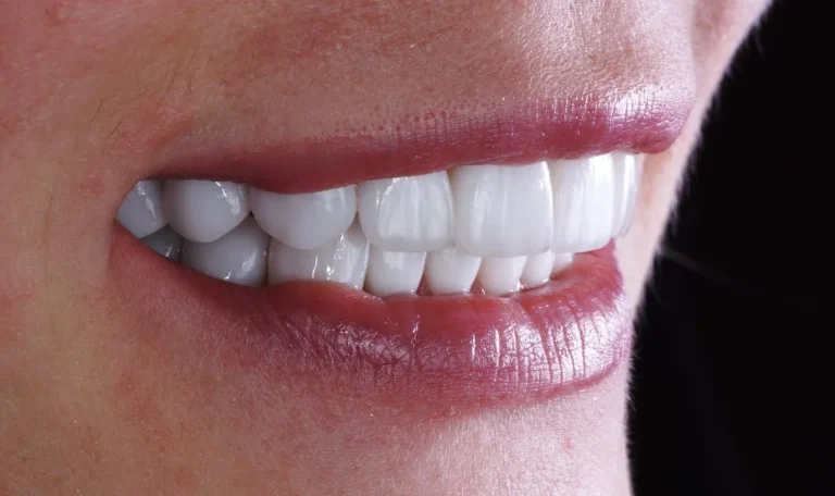 Zirkonyum Kaplama, Estetik Ve Dayanıklılık Sunarak Dişlerin Üzerine Uygulanan Yüksek Kaliteli Bir Kaplama Türüdür. Doğal Dişlere Yakın Bir Görünüm Sağlar.