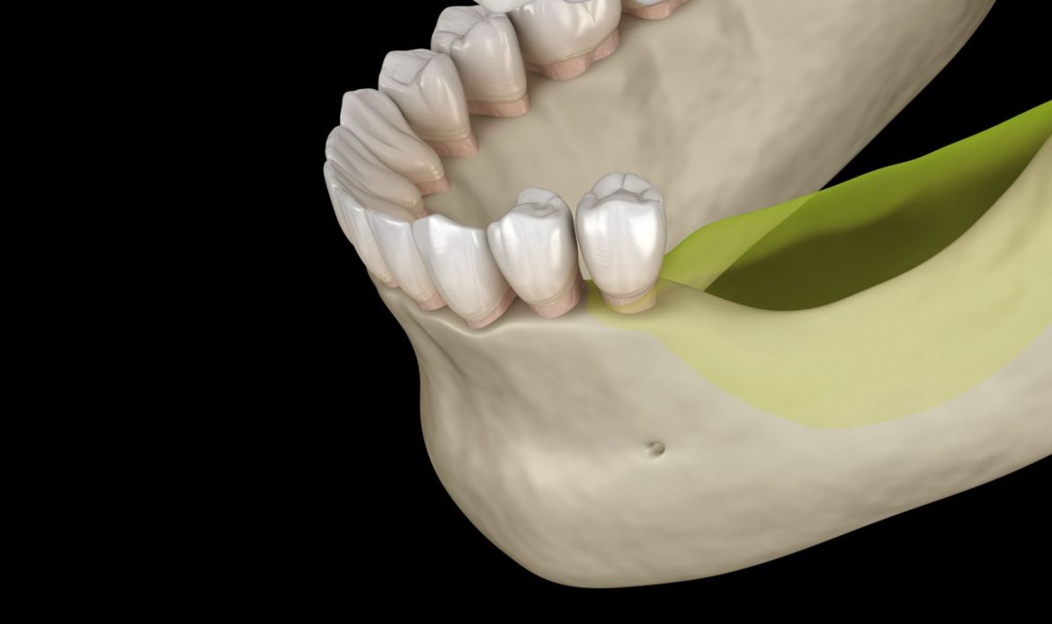 Diş Hekimi, Hastasına Çene Kemiği Erimesi Ve Implant Uygulanabilirliği Hakkında Bilgi Veriyor.
