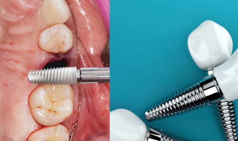 Diş Çekimi Sonrası Implant Yerleştirilen Bir Hastanın Ağız Içi Görüntüsü