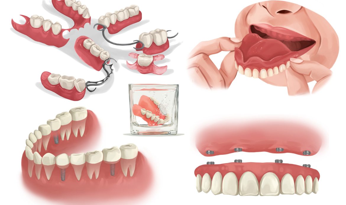 Bir Yanda Diş Protezi, Diğer Yanda Implant Modeli, Karşılaştırmalı Olarak Masada Sergileniyor.