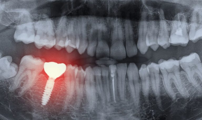 Diş Implantı Uygulaması Sonrası Çene Kemiği Yapısı Ve Kemik Erimesi Ilişkisini Gösteren Diş Röntgeni.
