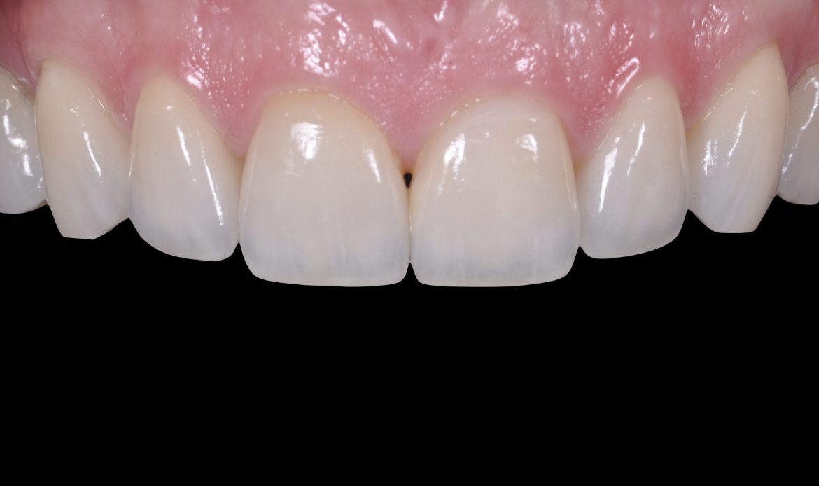 Yaprak Porselen Kaplama Yapılmış Estetik Bir Gülüşün Yakın Plan Klinik Fotoğrafı