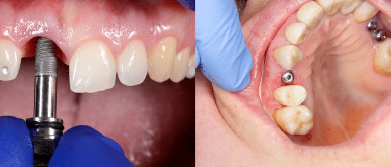 Ankara Sincan’da Modern Bir Diş Kliniğinde Hekim, Hastasına Implant Tedavisi Ve Fiyat Seçeneklerini Anlatıyor