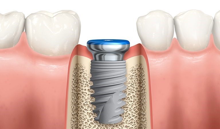 Ankara’da Bir Diş Kliniğinde Implant Tedavisi Öncesi Diş Hekimi, Hastasına Işlem Sırasında Anestezi Sayesinde Neredeyse Hiç Ağrı Hissedilmeyeceğini Sakin Bir Ortamda Anlatıyor.
