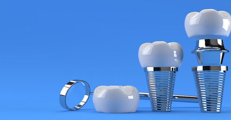 Ankara’da Bir Diş Kliniğinde, Diş Hekimi Hastaya Zirkonyum Implant Tedavisi Ve Fiyatları Hakkında Bilgi Verirken Görülüyor.