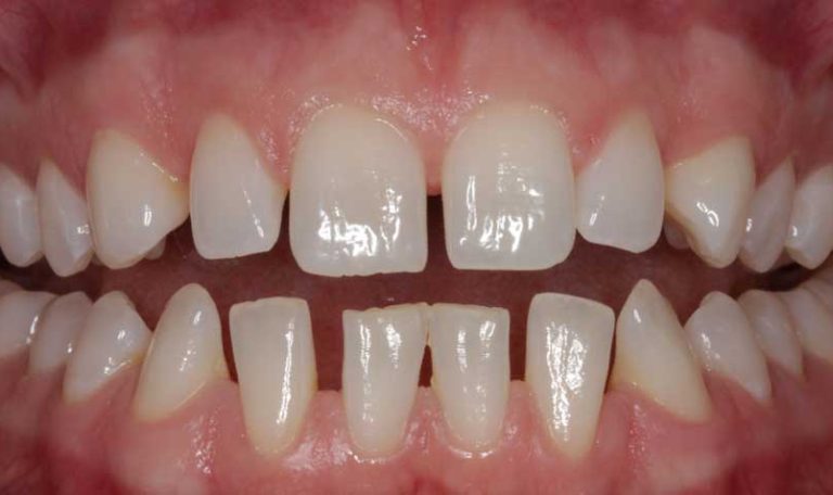 Diş Hekimi, Ön Dişlerindeki Boşluk Ve Şekil Bozukluklarını Diş Kesmeden Bonding (Estetik Dolgu) Ile Düzelttiği Hastanın Gülüş Tasarımını Yakından Gösteriyor.