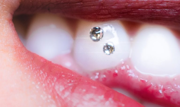 Pırlanta Görünümlü Küçük Bir Diş Takısının, Diş Hekimi Tarafından Üst Ön Dişe Özenle Yapıştırıldığı Yakın Plan Görüntü.