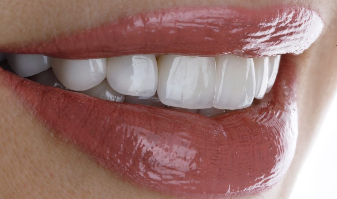 Zirkonyum Ve Porselen Diş Kaplamalarının Karşılaştırıldığı, Avantajları Ve Dezavantajları Hakkında Bilgilendiren Bir Görsel.