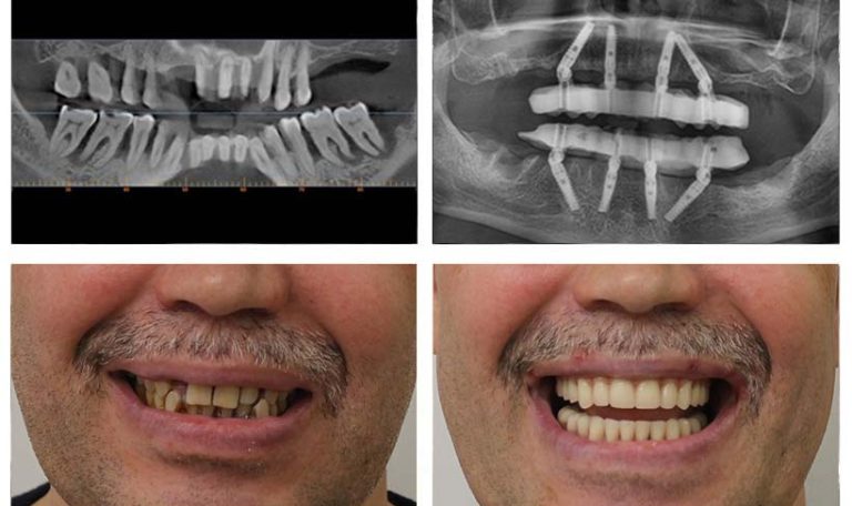 Ankara’da All On 4 Implant Tedavisi Ile Alt Ve Üst Çenesine Sabit Diş Protezi Yapılan Hasta Ve Tedavi Planını Anlatan Diş Hekimi