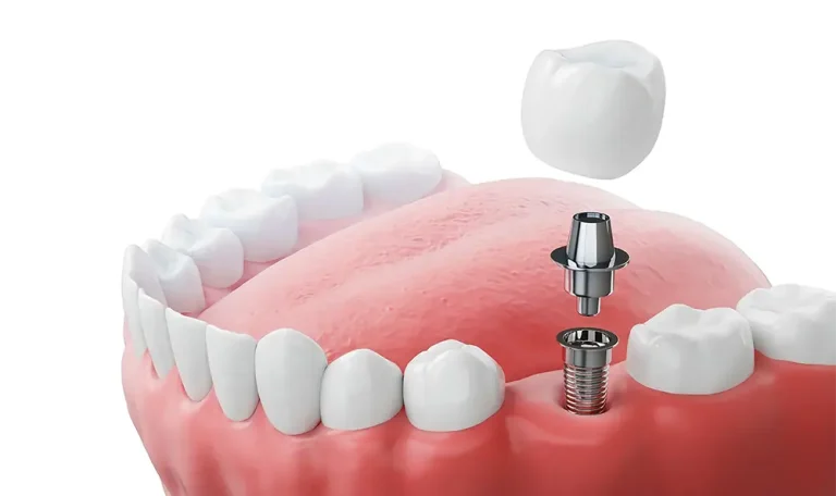 Ankara Kızılay’da Implant Diş Yaptırmak Isteyen Hastaya Tedavi Sürecini Anlatan Deneyimli Diş Hekimi