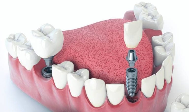 Ankara’da Aynı Gün Diş Çekimi Ve Implant Uygulaması Yapılan Modern Diş Kliniğinde Tedavi Gören Hasta