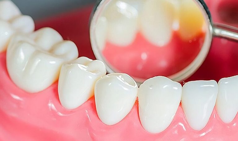 Ankara’da Implant Tedavisi Sonrası Dişlerini Fırçalayan Ve Bakım Önerilerini Dinleyen Hasta