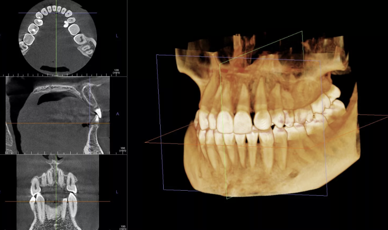 Ankara’da Üç Boyutlu Tomografi Ile Implant Planlaması Yapan Diş Hekimi, Hastanın Çene Yapısını Bilgisayar Ekranında Inceliyor