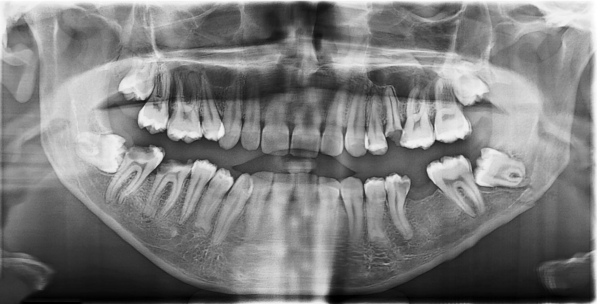 20’lik diş (gömülü 20’lik diş) röntgen görüntüsü