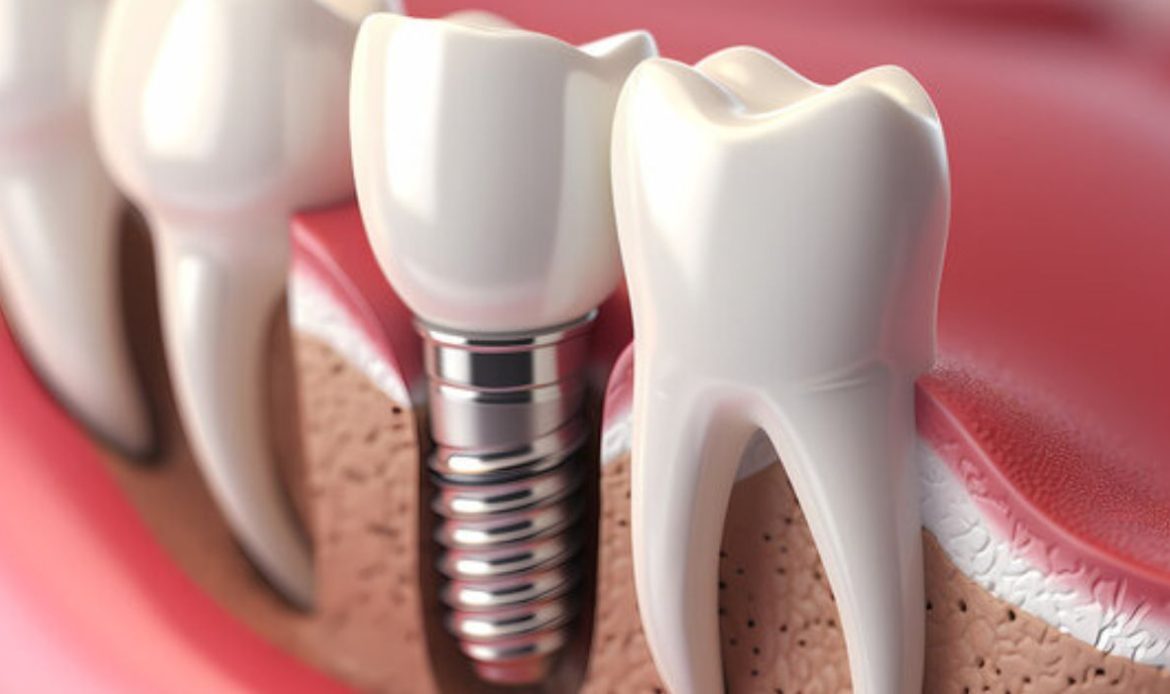 Ankara Dis Implant Tedavisi Yapan Yerler 1