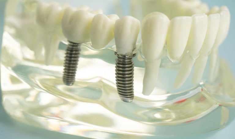 Ankara Implant Fiyatlari 2026 Surec Maliyet Ve Tedavi Asamalari