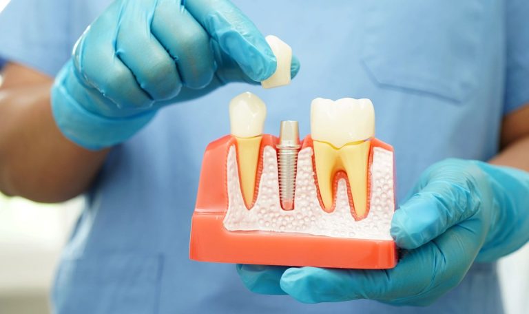 Dental Implant Ankarada Nerede Yapilabilir Dikkat Edilmesi Gerekenler 1