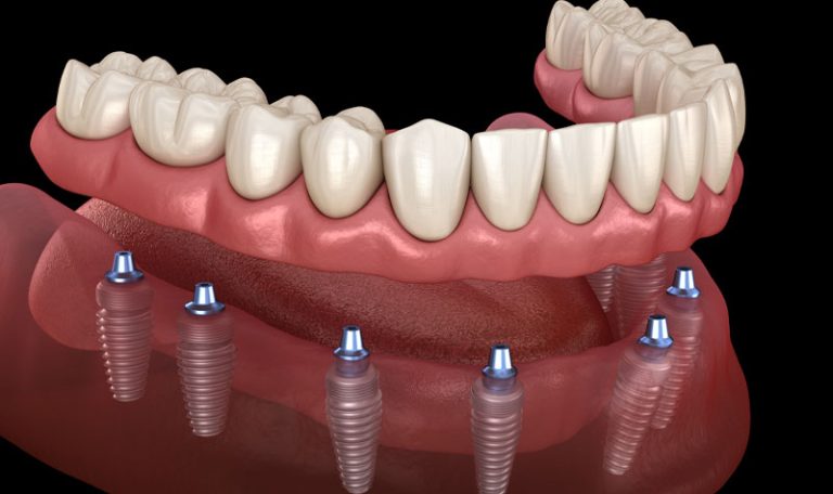 Dental Implant Kimler Icin Uygundur 1