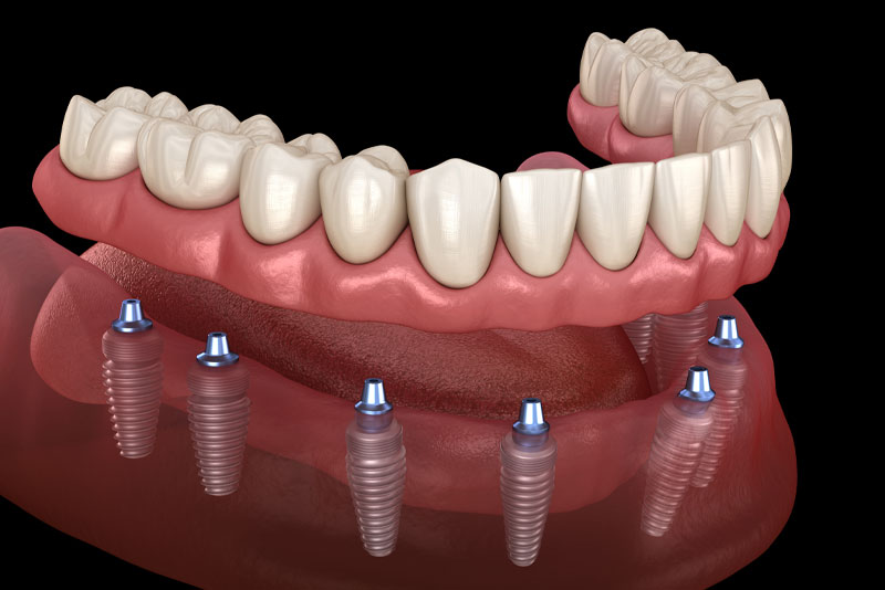 Dental Implant Kimler Icin Uygundur 1
