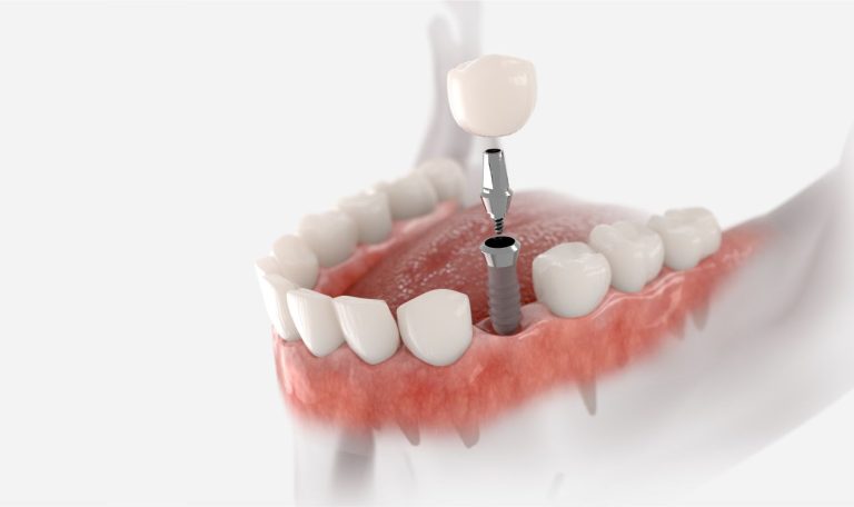 Dental Implant Tedavisi Ne Kadar Surer Iyilesme Suresi Ve Tedavi Asamalari