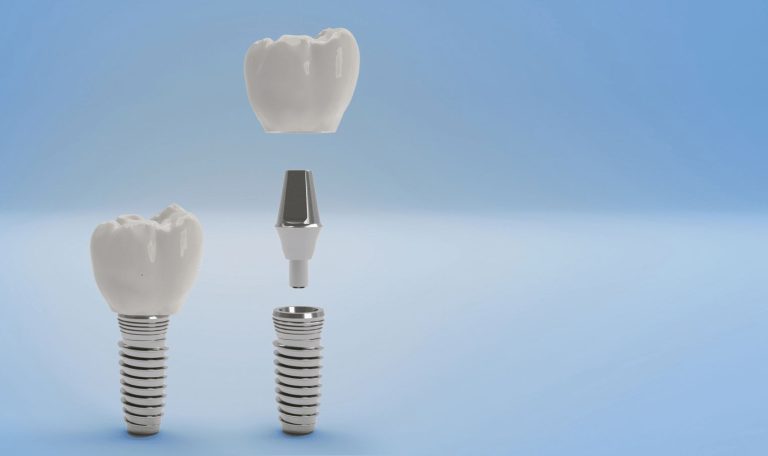 Dis Implanti Ne Kadar Dayanir Implant Omrunu Uzatan Faktorler 1