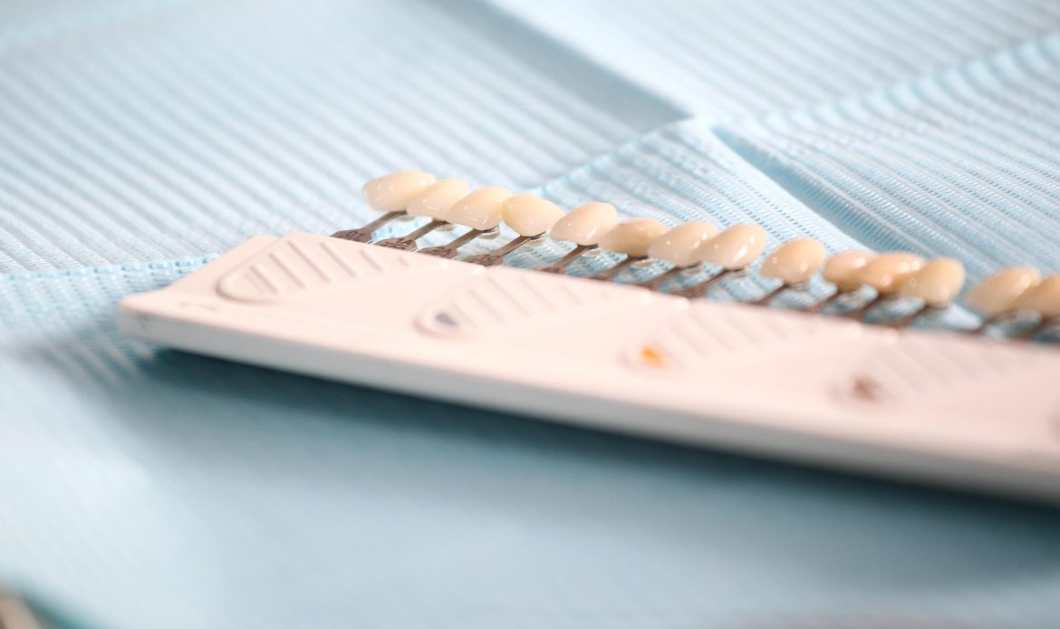 Gulus Estetigi Icin Laminate Veneer Neden Tercih Edilir