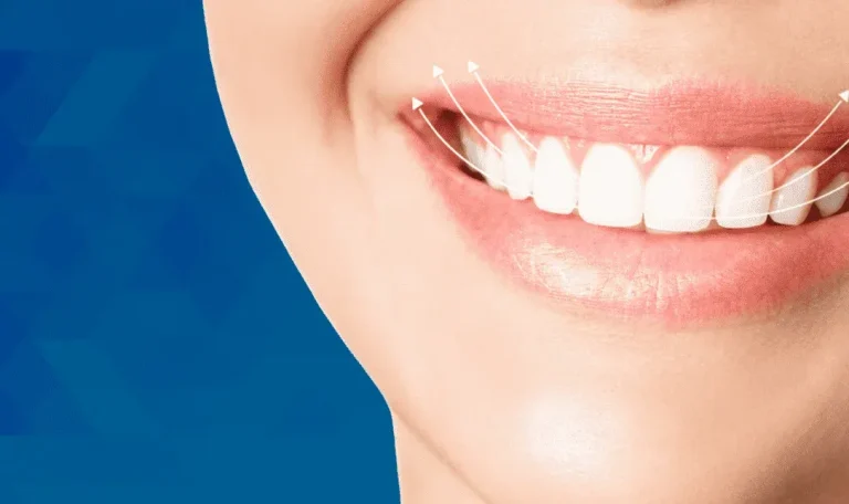 Gulus Tasarimi Ne Kadar Surer Tedavi Asamalari Nelerdir