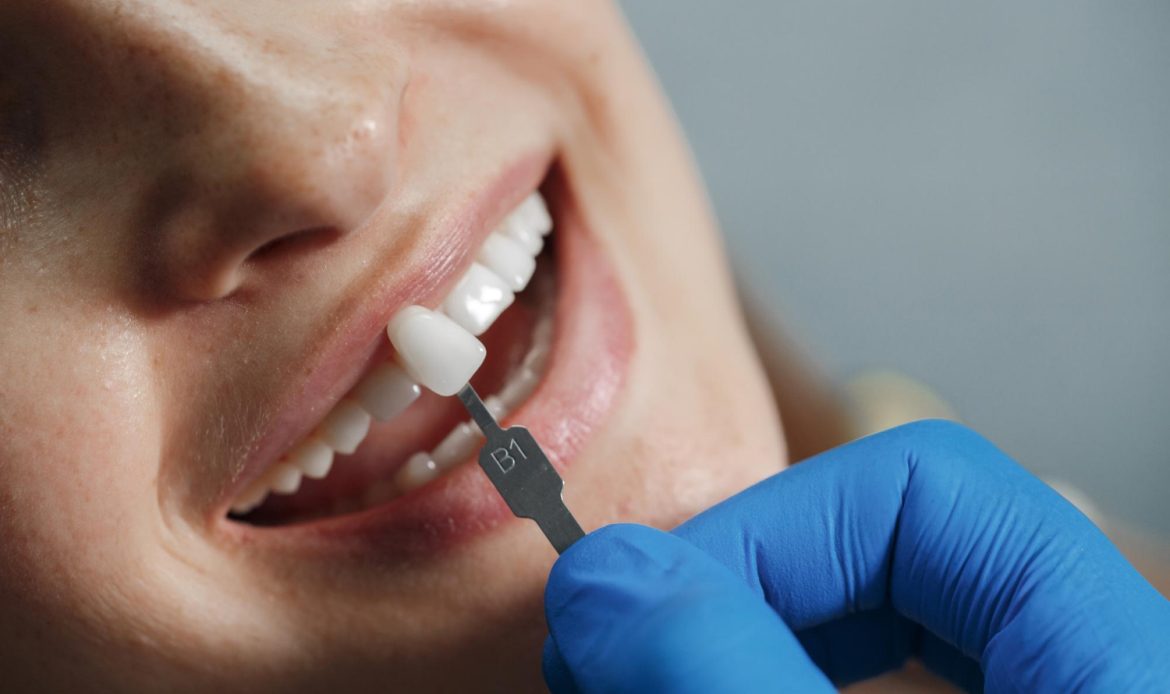 Laminate Veneer Hangi Dis Problemlerinde Tercih Edilir 1