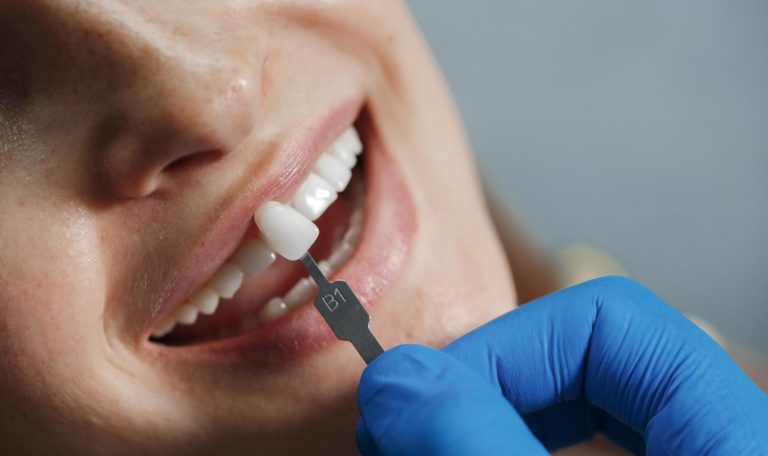 Laminate Veneer Hangi Dis Problemlerinde Tercih Edilir 1