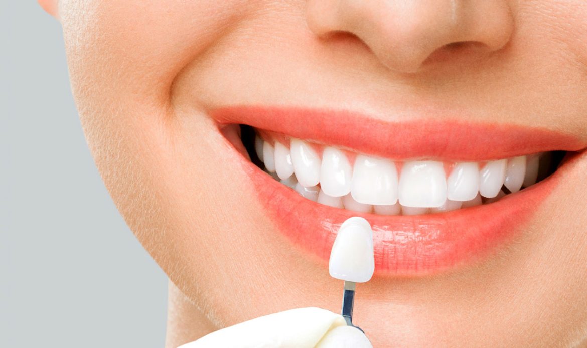 Laminate Veneer Kimler Icin Uygundur Avantajlari Ve Tedavi Sureci