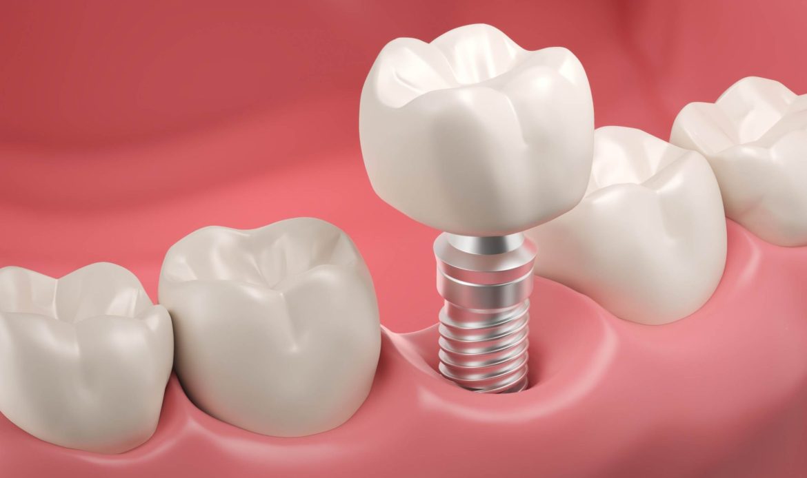 Tek Dis Eksikliginde Dental Implant Nasil Yapilir