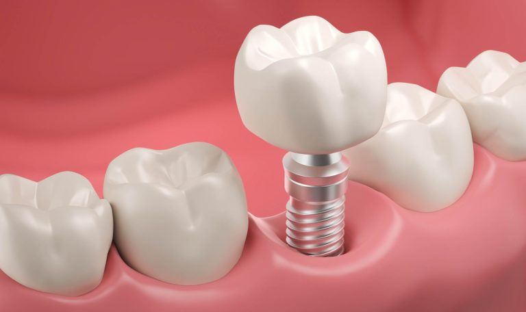 Tek Dis Eksikliginde Dental Implant Nasil Yapilir