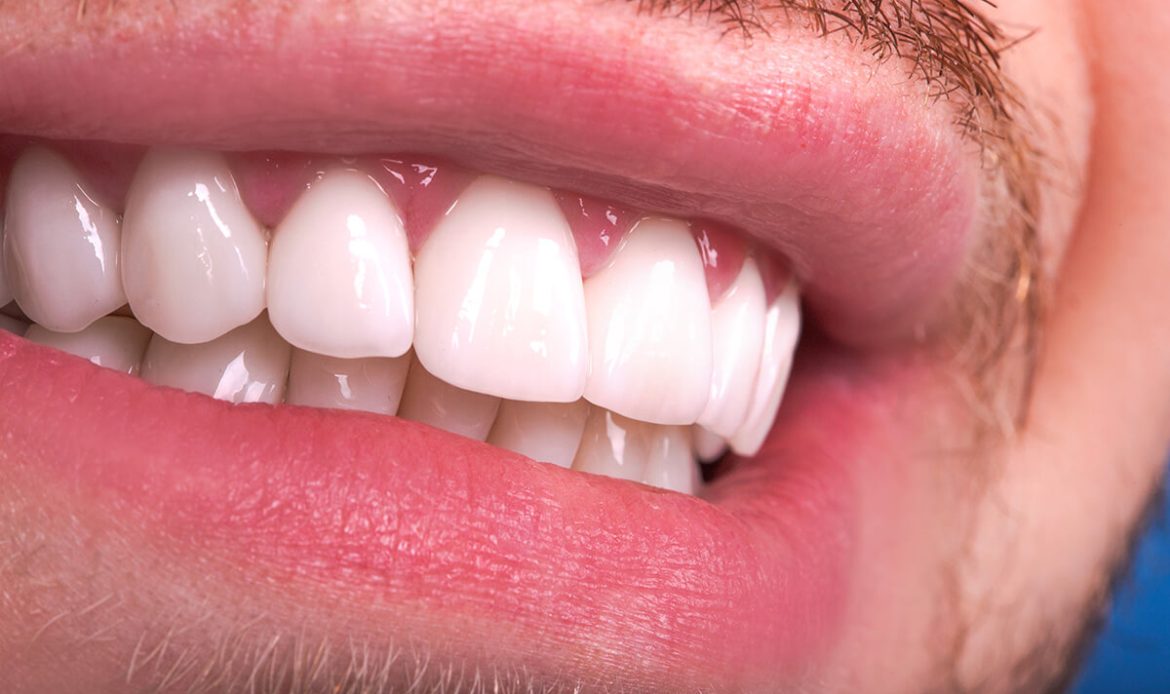 Zirkonyum Kaplama Sonrasi Bakim Nasil Olmalidir