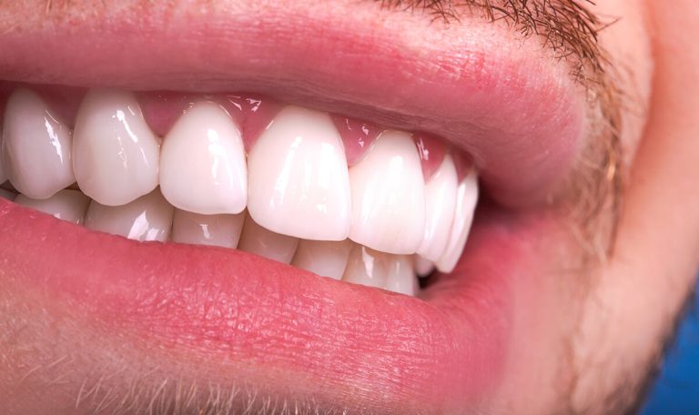 Zirkonyum Kaplama Sonrasi Bakim Nasil Olmalidir